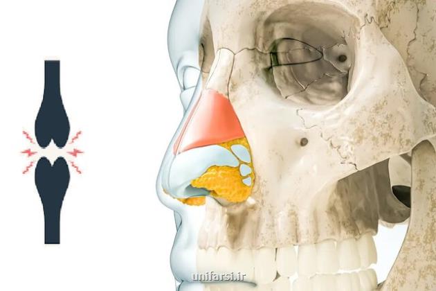 درمان مفاصل لطمه دیده زانو با کمک غضروف بینی